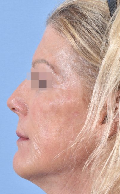 Fillers Before and After - Case 27, Image 6 - Female, age 45 – 54 - Baltimore, MD - Skin Therapeutics Med Spa