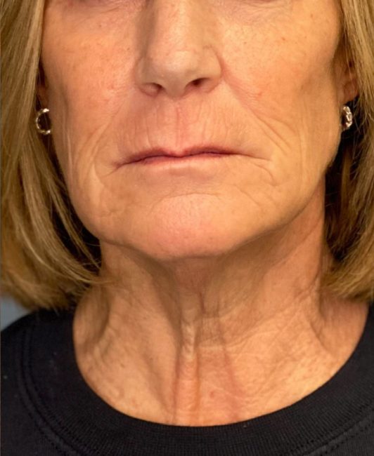 Fillers Before and After - Case 31, Image 6 - Female, age 45 – 54 - Baltimore, MD - Skin Therapeutics Med Spa