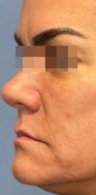 Fillers Before and After - Case 33, Image 6 - Female, age 35 – 44 - Baltimore, MD - Skin Therapeutics Med Spa