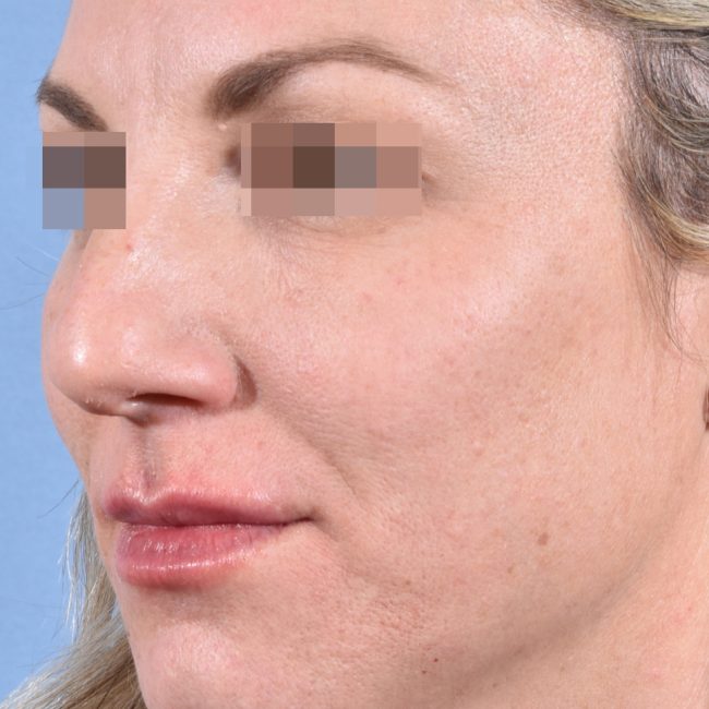 Fillers Before and After - Case 8, Image 6 - Female, age 25 – 34 - Baltimore, MD - Skin Therapeutics Med Spa