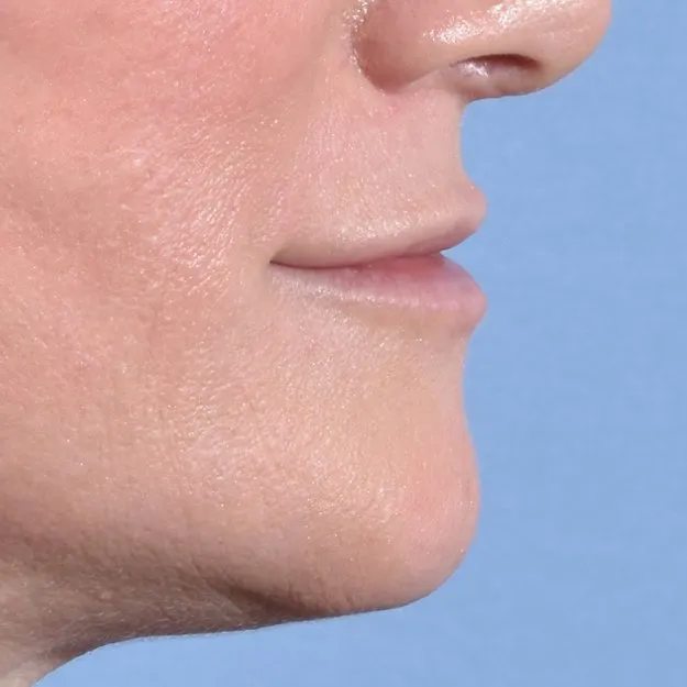 Fillers Before and After - Case 11, Image 6 - Female, age 35 – 44 - Baltimore, MD - Skin Therapeutics Med Spa