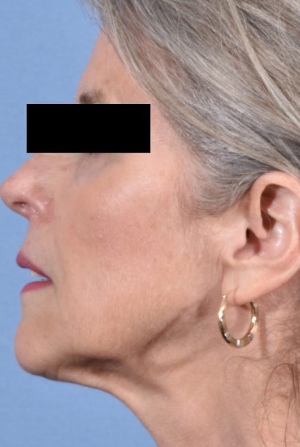 Fillers Before and After - Case 13, Image 6 - Female, age 55 – 64 - Baltimore, MD - Skin Therapeutics Med Spa