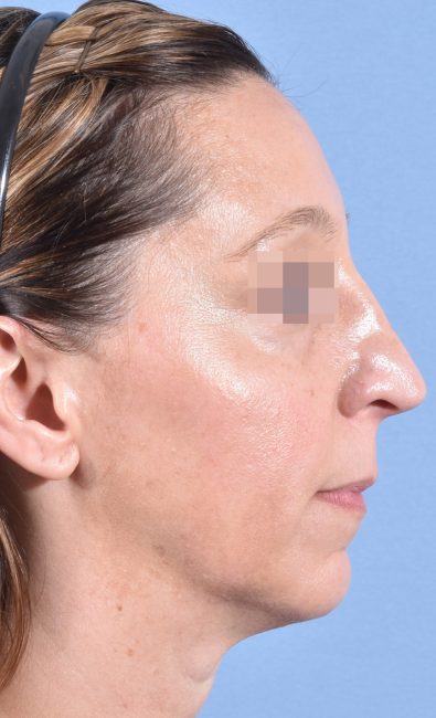 Fillers Before and After - Case 15, Image 6 - Female, age 35 – 44 - Baltimore, MD - Skin Therapeutics Med Spa