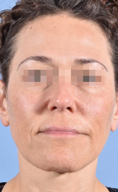 Fillers Before and After - Case 16, Image 6 - Female, age 35 – 44 - Baltimore, MD - Skin Therapeutics Med Spa