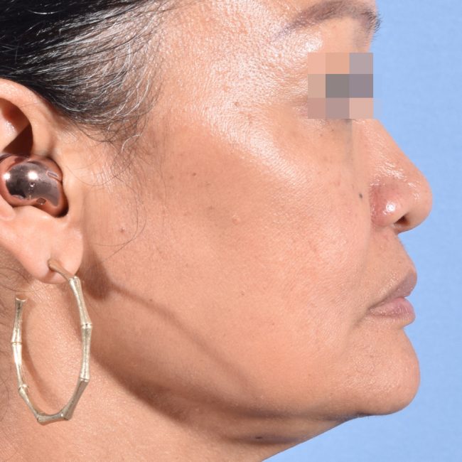 Fillers Before and After - Case 17, Image 6 - Female, age 35 – 44 - Baltimore, MD - Skin Therapeutics Med Spa