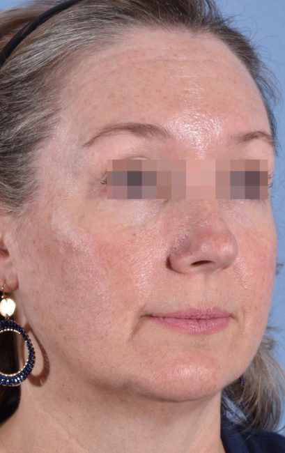 Fillers Before and After - Case 18, Image 6 - Female, age 35 – 44 - Baltimore, MD - Skin Therapeutics Med Spa