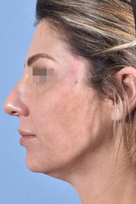 Fillers Before and After - Case 19, Image 6 - Female, age 25 – 34 - Baltimore, MD - Skin Therapeutics Med Spa