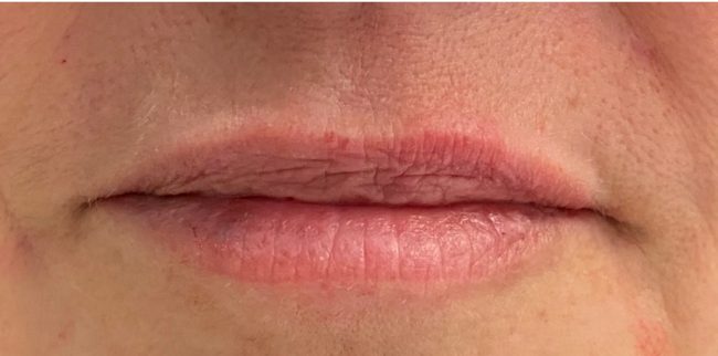 Fillers Before and After - Case 6, Image 2 - Female, age 35 – 44 - Baltimore, MD - Skin Therapeutics Med Spa