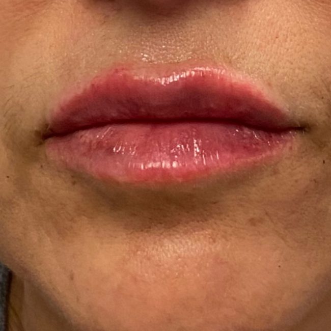 Fillers Before and After - Case 12, Image 2 - Female, age 35 – 44 - Baltimore, MD - Skin Therapeutics Med Spa