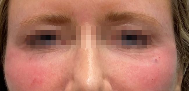 Fillers Before and After - Case 20, Image 2 - Female, age 35 – 44 - Baltimore, MD - Skin Therapeutics Med Spa