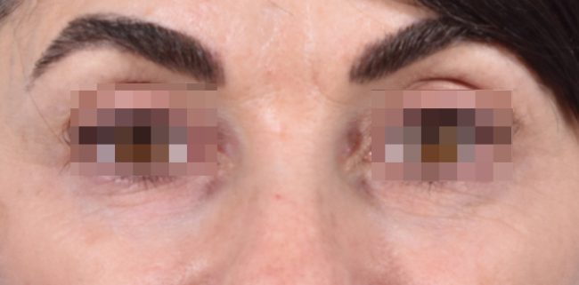 Fillers Before and After - Case 23, Image 2 - Female, age 35 – 44 - Baltimore, MD - Skin Therapeutics Med Spa