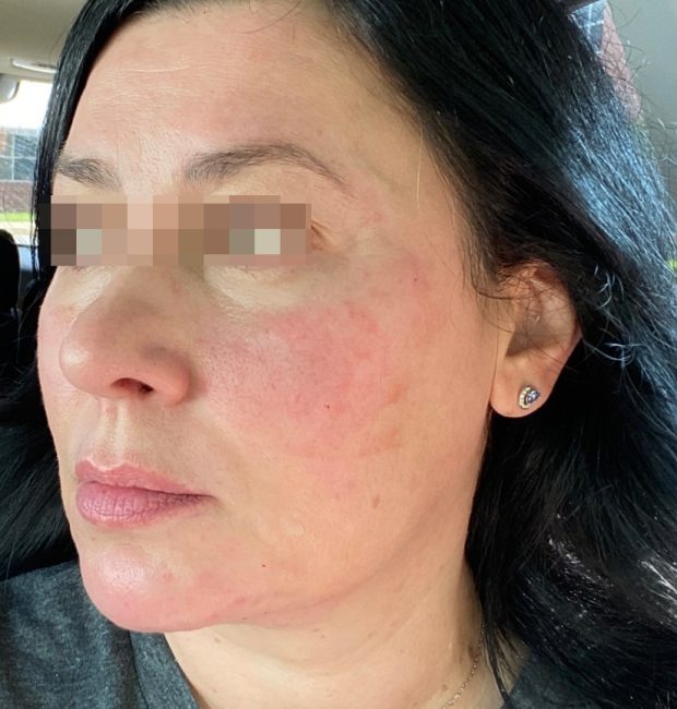 Fillers Before and After - Case 24, Image 2 - Female, age 35 – 44 - Baltimore, MD - Skin Therapeutics Med Spa