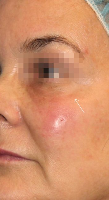 Fillers Before and After - Case 25, Image 2 - Female, age 35 – 44 - Baltimore, MD - Skin Therapeutics Med Spa