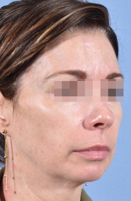 Fillers Before and After - Case 14, Image 8 - Female, age 35 – 44 - Baltimore, MD - Skin Therapeutics Med Spa