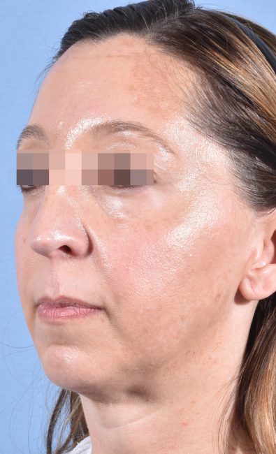 Fillers Before and After - Case 15, Image 8 - Female, age 35 – 44 - Baltimore, MD - Skin Therapeutics Med Spa