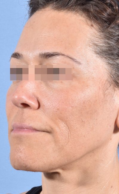 Fillers Before and After - Case 16, Image 8 - Female, age 35 – 44 - Baltimore, MD - Skin Therapeutics Med Spa