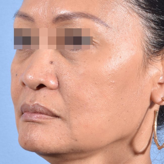 Fillers Before and After - Case 17, Image 8 - Female, age 35 – 44 - Baltimore, MD - Skin Therapeutics Med Spa