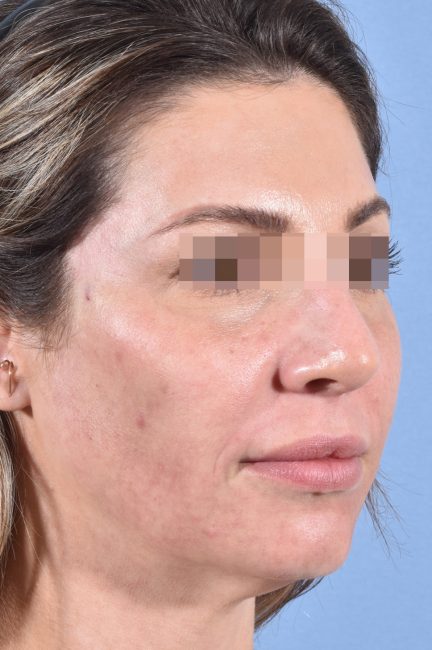 Fillers Before and After - Case 19, Image 8 - Female, age 25 – 34 - Baltimore, MD - Skin Therapeutics Med Spa