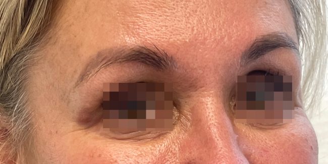 Dysport Before and After - Case 8, Image 2 - Female, age 45 – 54 - Baltimore, MD - Skin Therapeutics Med Spa