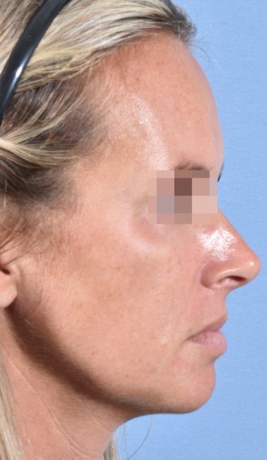 Fillers Before and After - Case 26, Image 8 - Female, age 25 – 34 - Baltimore, MD - Skin Therapeutics Med Spa