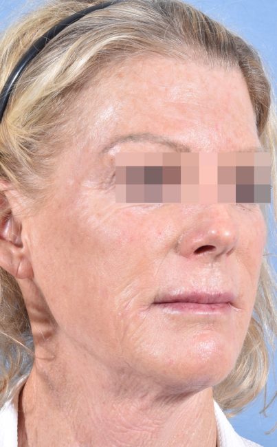 Fillers Before and After - Case 27, Image 8 - Female, age 45 – 54 - Baltimore, MD - Skin Therapeutics Med Spa