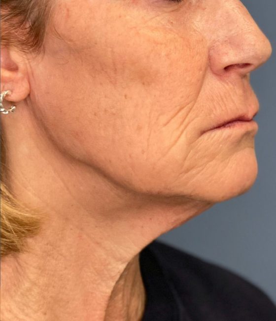 Fillers Before and After - Case 31, Image 8 - Female, age 45 – 54 - Baltimore, MD - Skin Therapeutics Med Spa