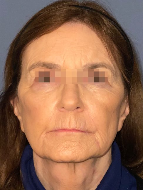 Fillers Before and After - Case 32, Image 2 - Female, age 55 – 64 - Baltimore, MD - Skin Therapeutics Med Spa