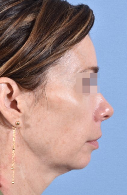 Fillers Before and After - Case 14, Image 10 - Female, age 35 – 44 - Baltimore, MD - Skin Therapeutics Med Spa