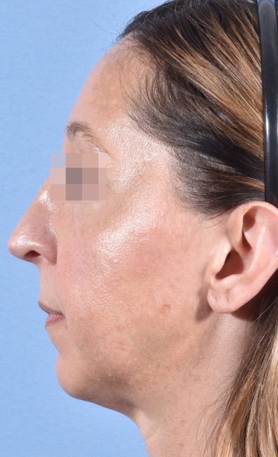 Fillers Before and After - Case 15, Image 10 - Female, age 35 – 44 - Baltimore, MD - Skin Therapeutics Med Spa