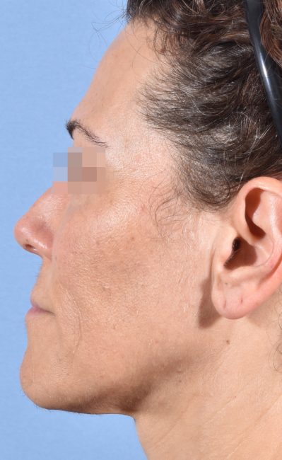 Fillers Before and After - Case 16, Image 10 - Female, age 35 – 44 - Baltimore, MD - Skin Therapeutics Med Spa