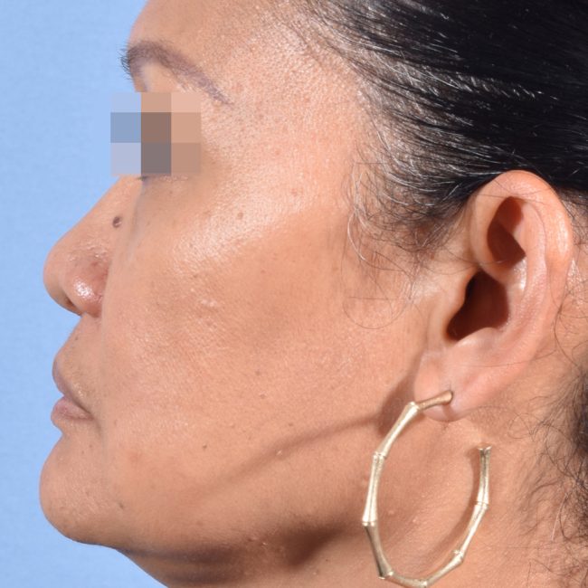 Fillers Before and After - Case 17, Image 10 - Female, age 35 – 44 - Baltimore, MD - Skin Therapeutics Med Spa