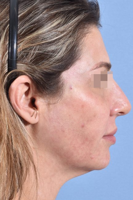 Fillers Before and After - Case 19, Image 10 - Female, age 25 – 34 - Baltimore, MD - Skin Therapeutics Med Spa