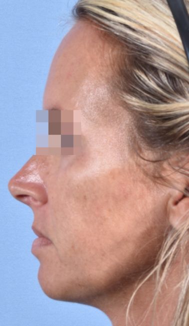 Fillers Before and After - Case 26, Image 10 - Female, age 25 – 34 - Baltimore, MD - Skin Therapeutics Med Spa