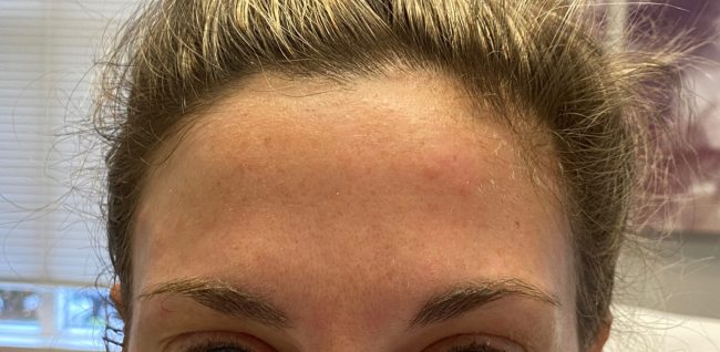 Botox Before and After - Case 9, Image 2 - Female, age 25 – 34 - Baltimore, MD - Skin Therapeutics Med Spa