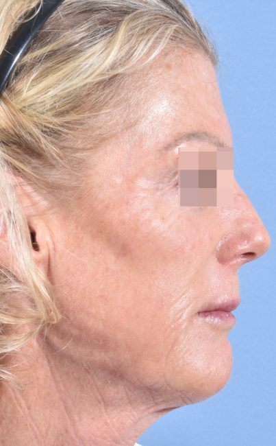 Fillers Before and After - Case 27, Image 10 - Female, age 45 – 54 - Baltimore, MD - Skin Therapeutics Med Spa