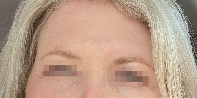 Dysport Before and After - Case 9, Image 2 - Female, age 35 – 44 - Baltimore, MD - Skin Therapeutics Med Spa