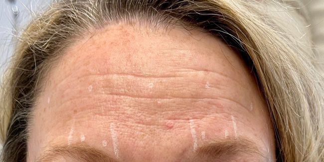 Dysport Before and After - Case 10, Image 1 - Female, age 35 – 44 - Baltimore, MD - Skin Therapeutics Med Spa