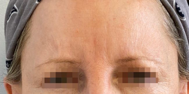 Botox Before and After - Case 6, Image 2 - Female, age 45 – 54 - Baltimore, MD - Skin Therapeutics Med Spa