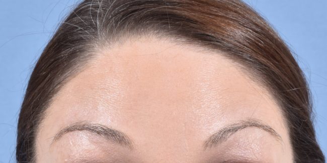 Botox Before and After - Case 5, Image 2 - Female, age 35 – 44 - Baltimore, MD - Skin Therapeutics Med Spa