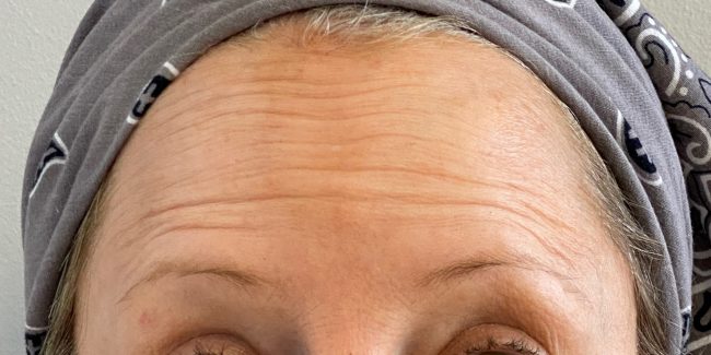 Botox Before and After - Case 6, Image 4 - Female, age 45 – 54 - Baltimore, MD - Skin Therapeutics Med Spa