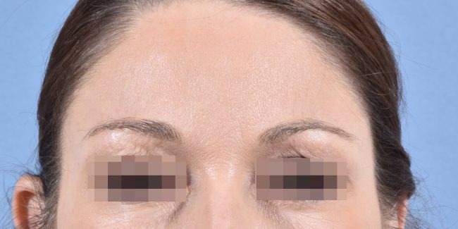 Botox Before and After - Case 5, Image 4 - Female, age 35 – 44 - Baltimore, MD - Skin Therapeutics Med Spa