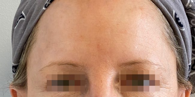 Botox Before and After - Case 6, Image 6 - Female, age 45 – 54 - Baltimore, MD - Skin Therapeutics Med Spa