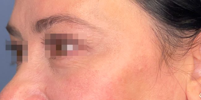 Dysport Before and After - Case 2, Image 2 - Female, age 35 – 44 - Baltimore, MD - Skin Therapeutics Med Spa