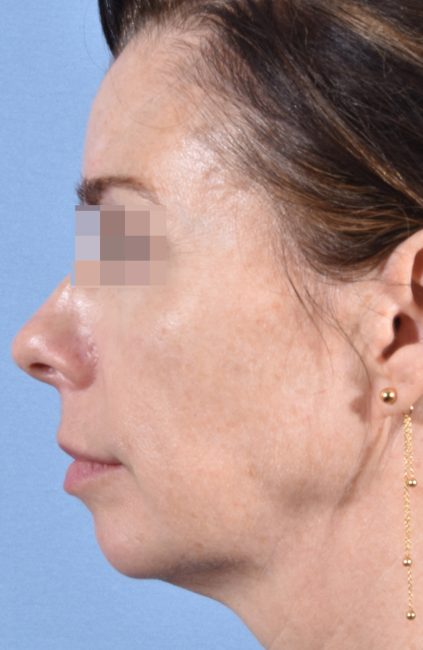 Fillers Before and After - Case 14, Image 6 - Female, age 35 – 44 - Baltimore, MD - Skin Therapeutics Med Spa