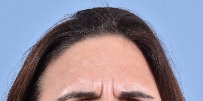 Dysport Before and After - Case 4, Image 1 - Female, age 25 – 34 - Baltimore, MD - Skin Therapeutics Med Spa