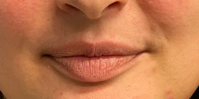 Fillers Before and After - Case 7, Image 1 - Female, age 18 – 24 - Baltimore, MD - Skin Therapeutics Med Spa