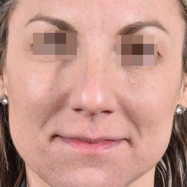 Fillers Before and After - Case 8, Image 1 - Female, age 25 – 34 - Baltimore, MD - Skin Therapeutics Med Spa