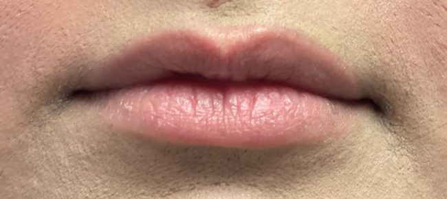 Fillers Before and After - Case 10, Image 1 - Female, age 25 – 34 - Baltimore, MD - Skin Therapeutics Med Spa