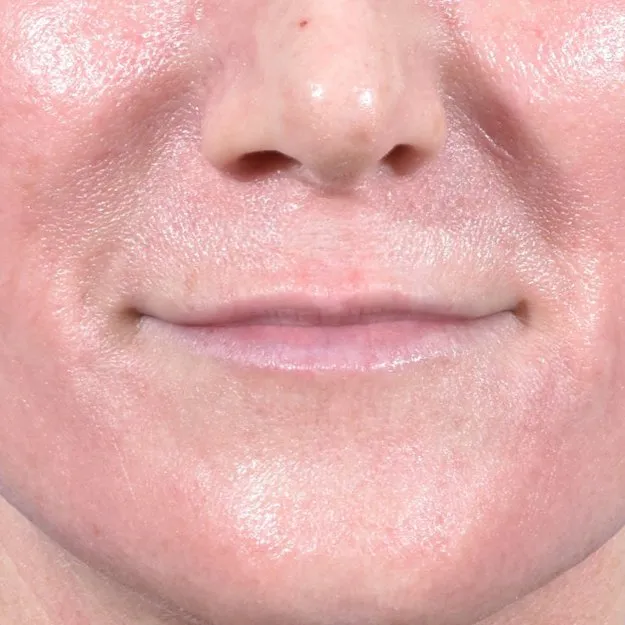 Fillers Before and After - Case 11, Image 1 - Female, age 35 – 44 - Baltimore, MD - Skin Therapeutics Med Spa