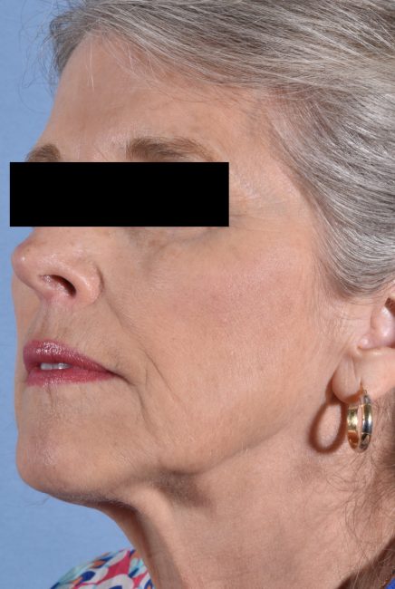 Fillers Before and After - Case 13, Image 1 - Female, age 55 – 64 - Baltimore, MD - Skin Therapeutics Med Spa